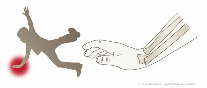 Травма руки при падении. Падение на вытянутые руки. падение на вытянутую руку. переломы костей при падении.