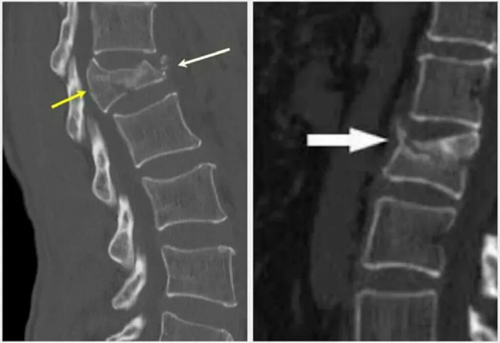 Компрессионный перелом c5 c6. Компрессионный перелом рентген. Остеопороз компрессионный перелом позвоночника. Компрессионный перелом th4 что это такое. Трещина заднего зажила