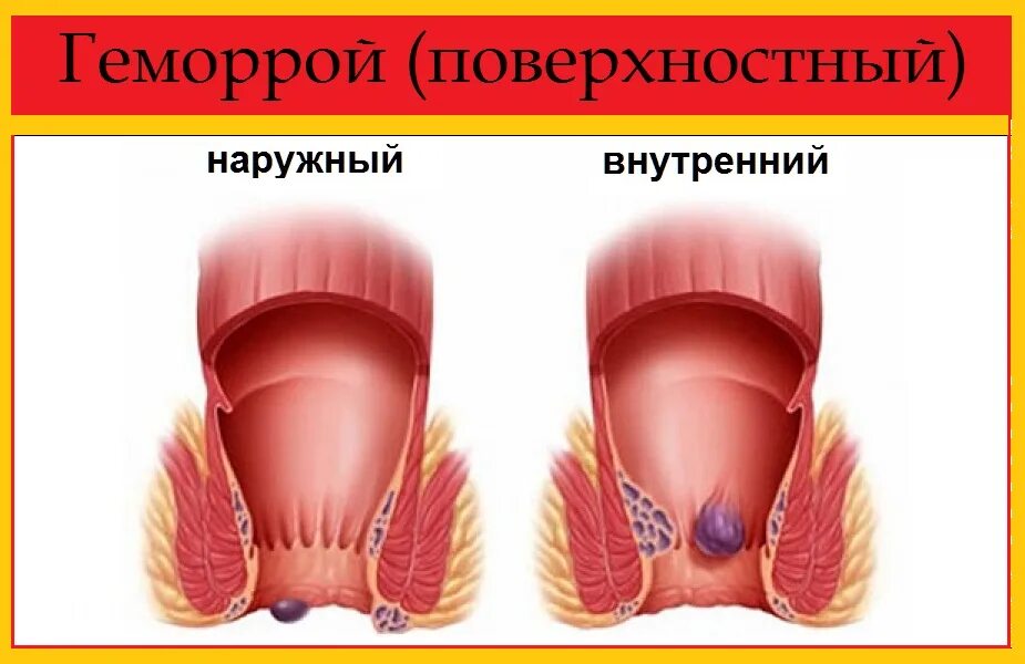 Врач при геморрое у мужчин. Геморрой наружный наружный. Внешний геморроидальный узел.