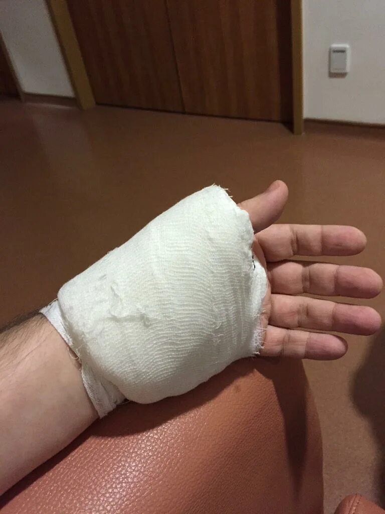Бинт смена рук. Перебентовананая рука.