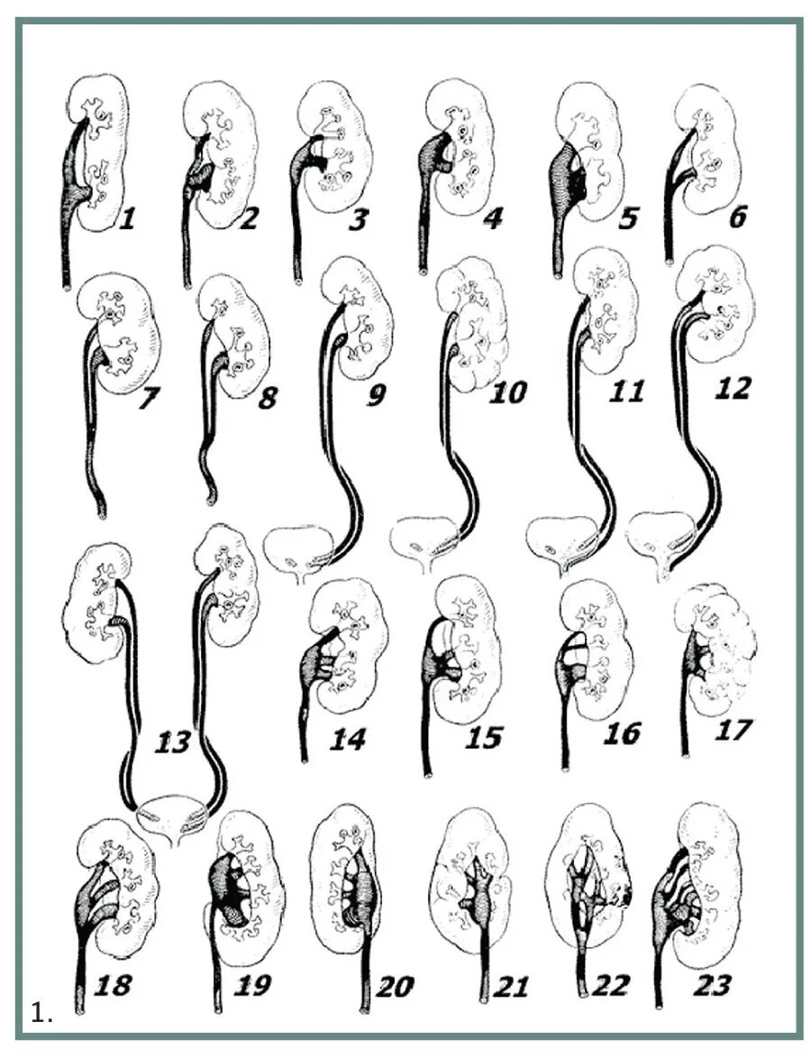 Удвоение мочеточника. Неполное удвоение почки классификация. Пороки развития почек удвоение. Аномалии развития ЧЛС почек. Аномалии развития почек неполное удвоение.