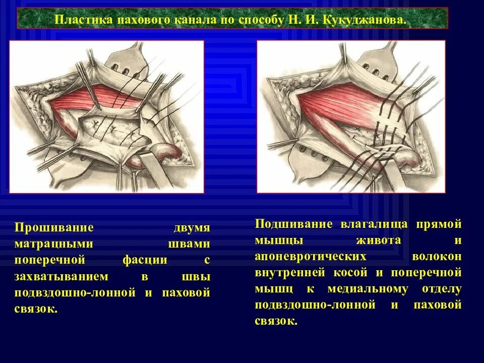 Задняя стенка пахового. Задняя стенка пахового. Пластика задней стенки пахового канала. Нижняя стенка пахового канала. Передняя стенка пахового канала.