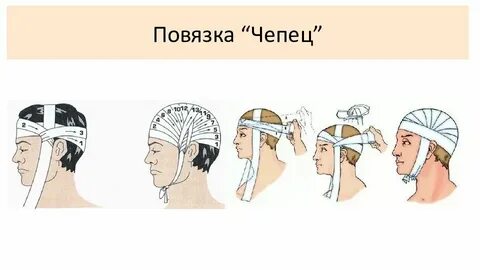 Повязка чепец алгоритм наложения