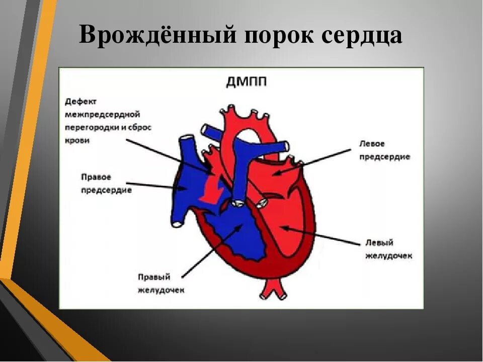 Впс премиум. Дефект межпредсердной перегородки схема. врожденный порок сердца дмпп. врождённый порок сердца межпредсердной перегородки. впс-дмпп- дефект межпредсердной перегородки.