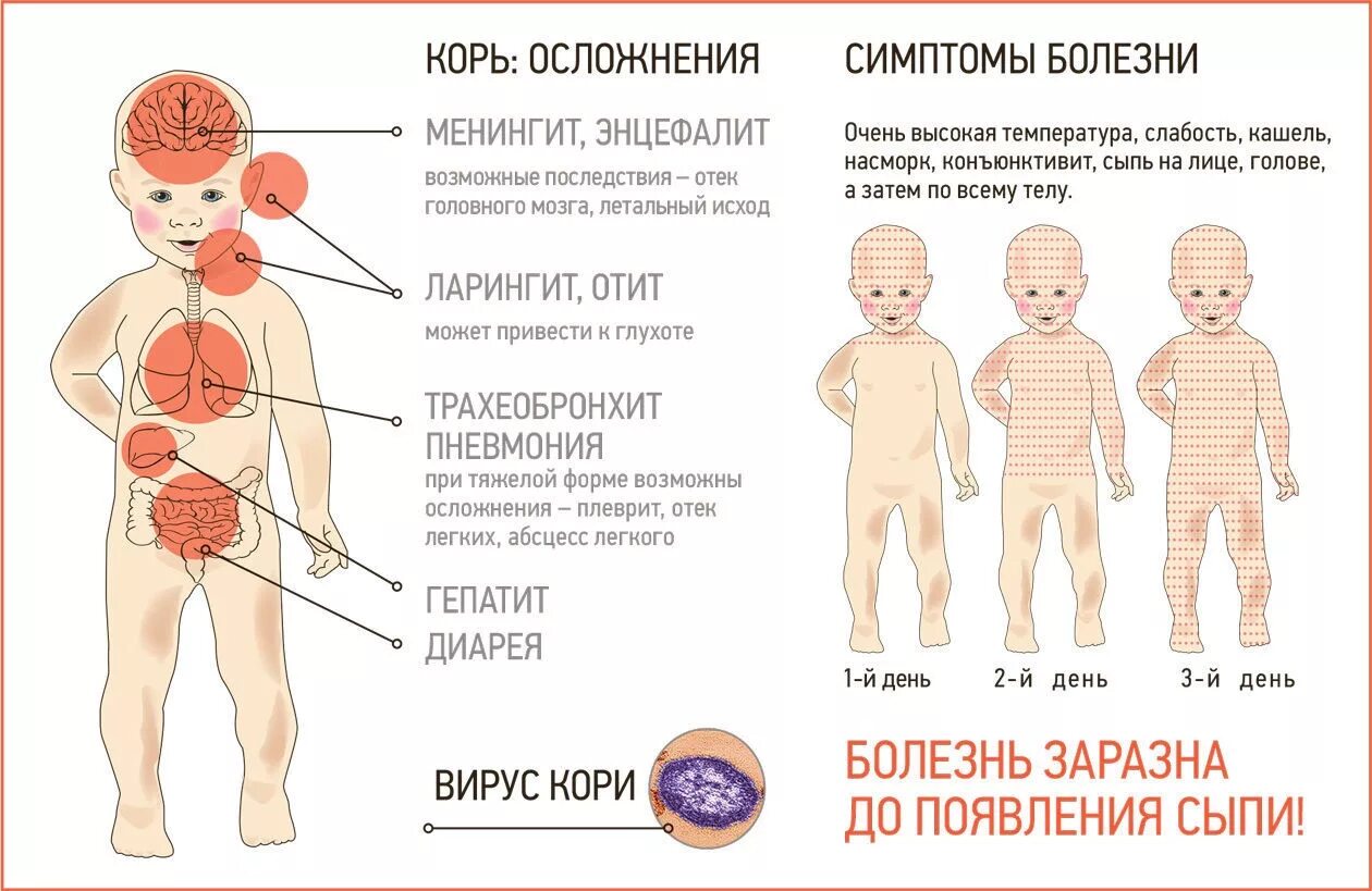 Ли заболеть корью если есть прививка