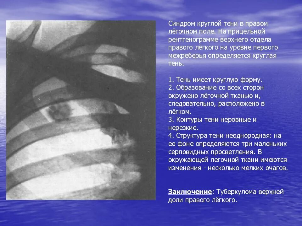 Синдром круглой тени на рентгенограмме. Синдром круглой тени в легочном поле. Круглая тень в легочном поле. Круглая тень на рентгенограмме легких. Тени в верхней доле легкого