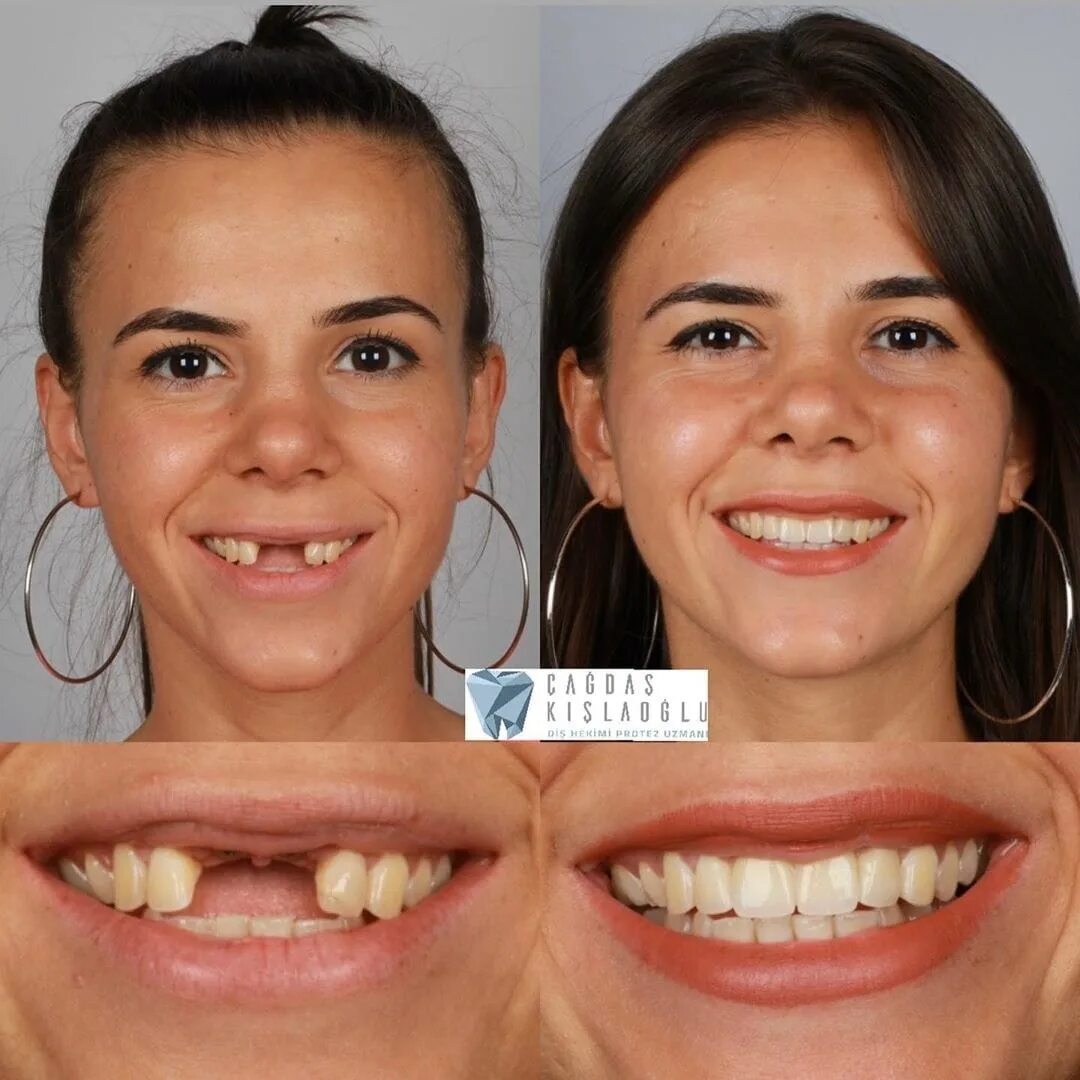 Зубы после 30. Красивые зубы фото до и после. Ровные зубы.