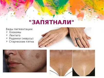 Виды пигментации