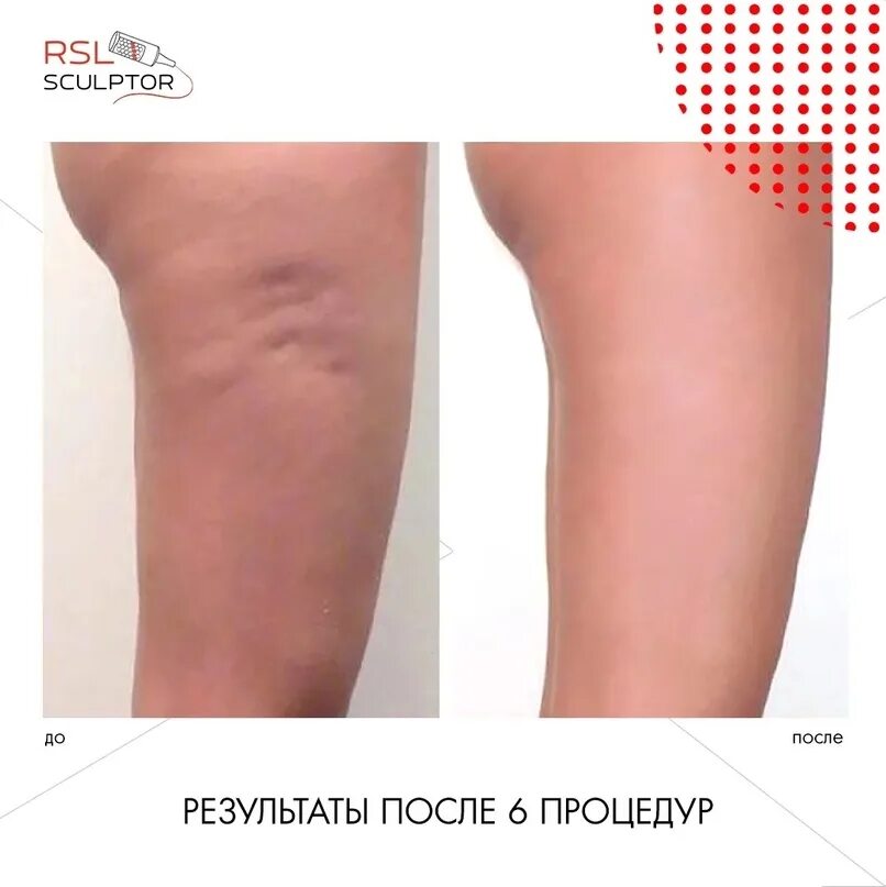 Рсл массаж