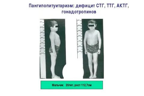 Дефицит роста