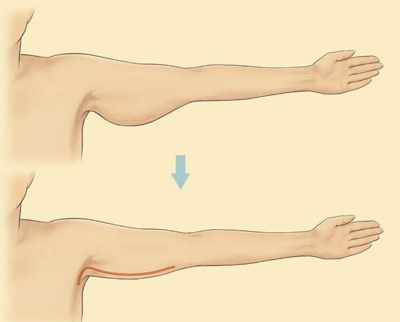 Причина толстых рук. Упражнения для обвисшей кожи на руках. Занятие для рук обвисшая кожа. Гимнастика для обвисших рук.