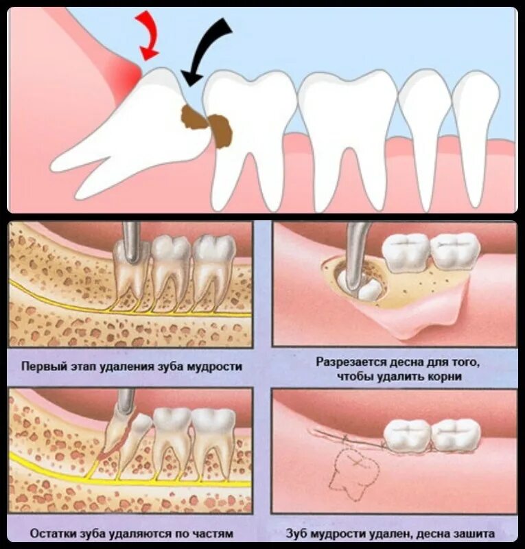 Лечат 8 зуб. Удалили 8 зуб снизу мудрости. Как удаляют зуб мудрости.