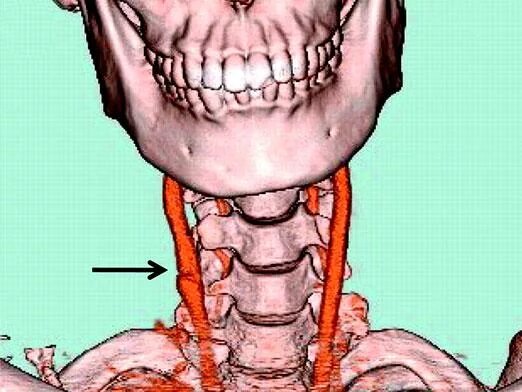 Сонная артерия где находится. Проекция левой общей сонной артерии. Правая сонная артерия где находится
