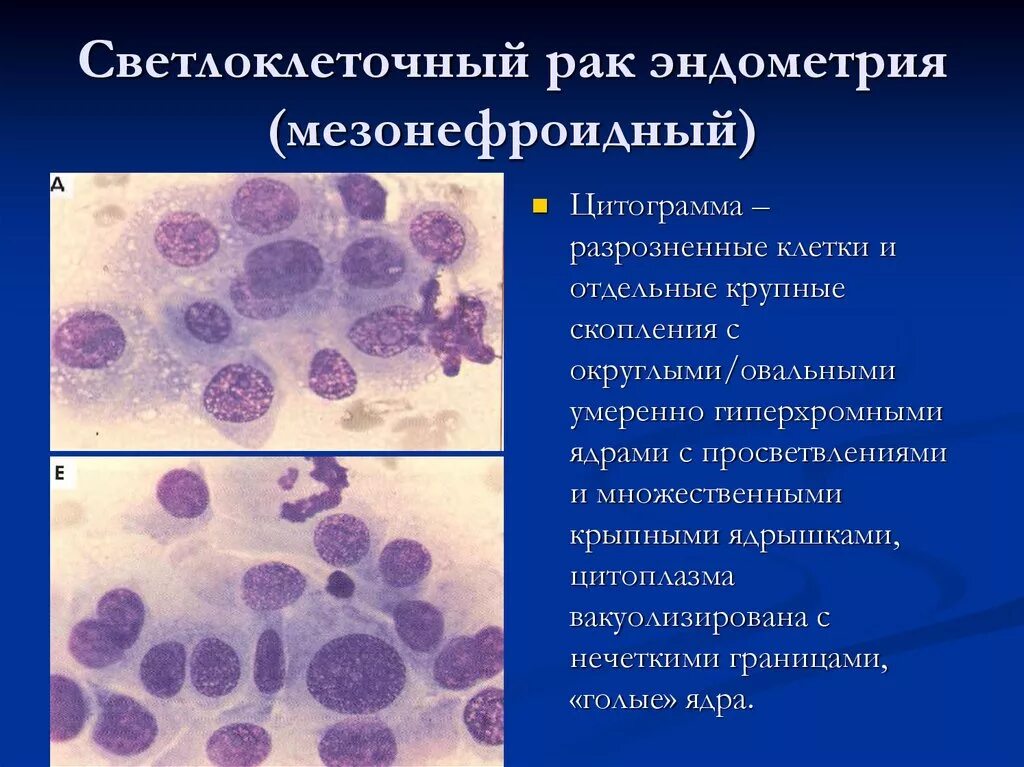 Цитологические и гистологические исследования. Светлоклеточные мезонефроидные опухоли. Лёгкая дисплазия плоского эпителия. Цитологическое и гистологическое исследование. Цитологическое исследование опухоли.