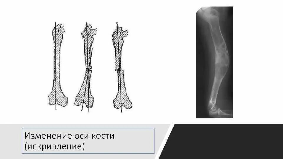 Изм оси. Постостеомиелитическая деформация костей. Ось кости. Оси костей. Осевая кость.