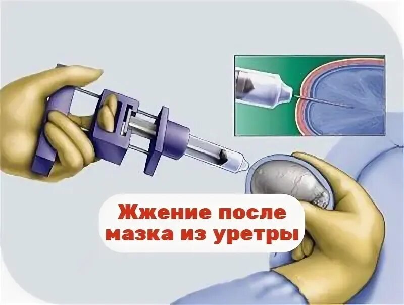 После мазка из уретры. После мазка из уретры