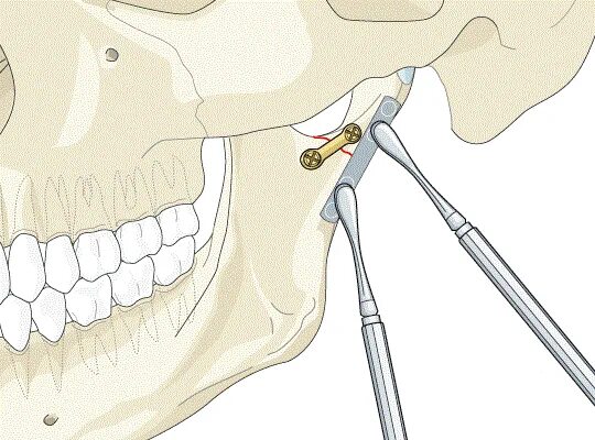 Мыщелки челюсти. Перелом мыщелкового отростка челюсти. Остеосинтез мыщелкового отростка нижней челюсти. Перелом мыщелкового отростка нижней челюсти. Перелом суставного отростка челюсти.