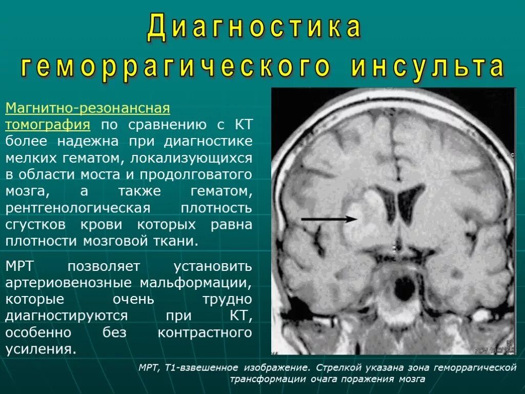 Кровоизлияние ствола мозга. Геморрагический инсульт кт. Таламический геморрагический инсульт. Презентация на тему геморрагический инсульт. Геморрагический инсульт кровоизлияние в мозг.