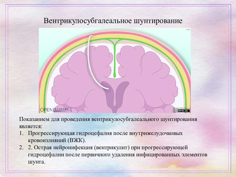 Гидроцефалия шунтирование мозга. Шунтирование гидроцефалии головного мозга. Вентрикулоперитонеальный шунт. Вентрикуло шунтирование. Вентрикулярный шунт при гидроцефалии.