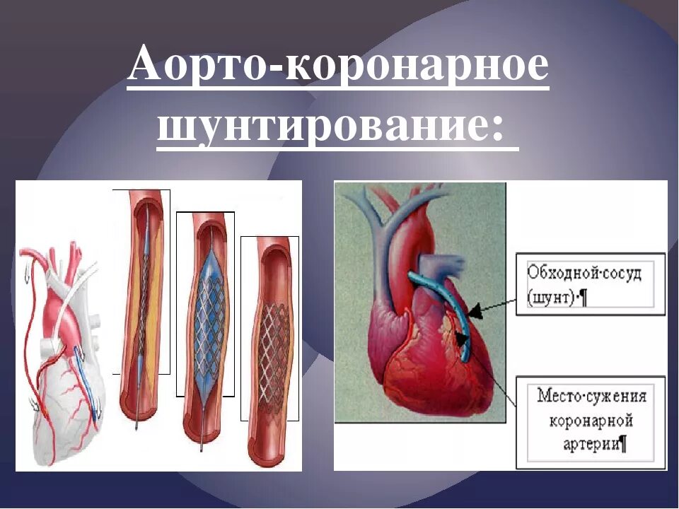 Шунтирование коронарных артерий. Коронарное шунтирование сосудов. Аортокоронарное шунтирование хирургия.
