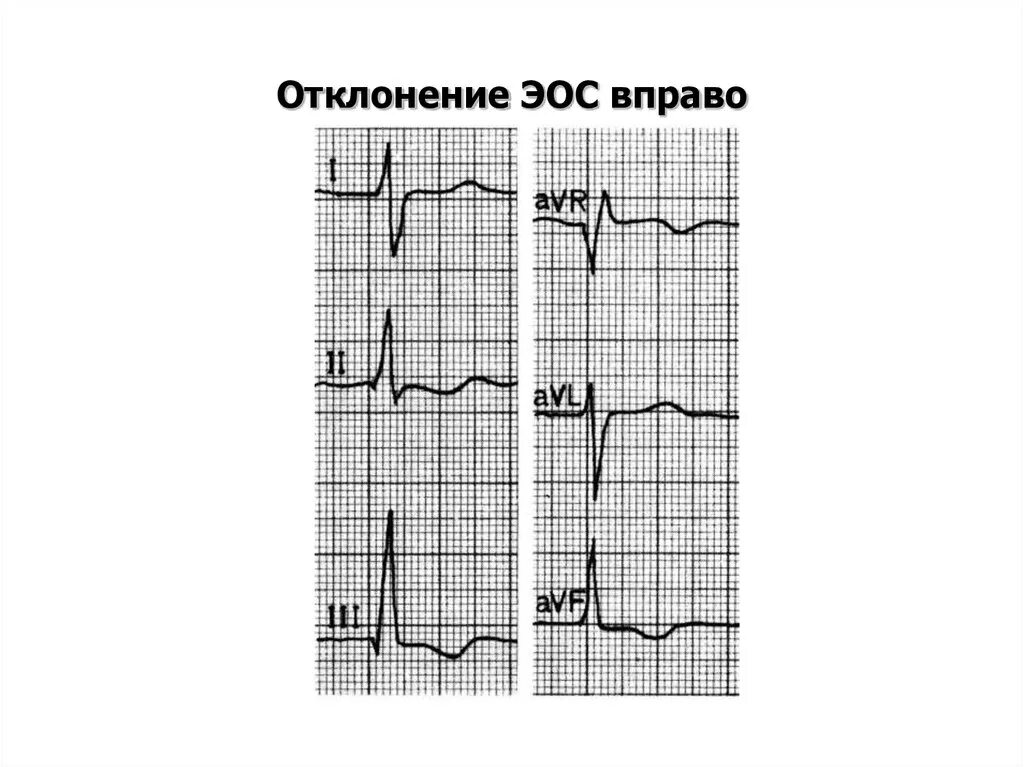 S тип эос. Отклонение оси влево на экг. экг при отклонении эос вправо. резкое отклонение эос вправо на экг. электрическая ось сердца отклонена вправо.