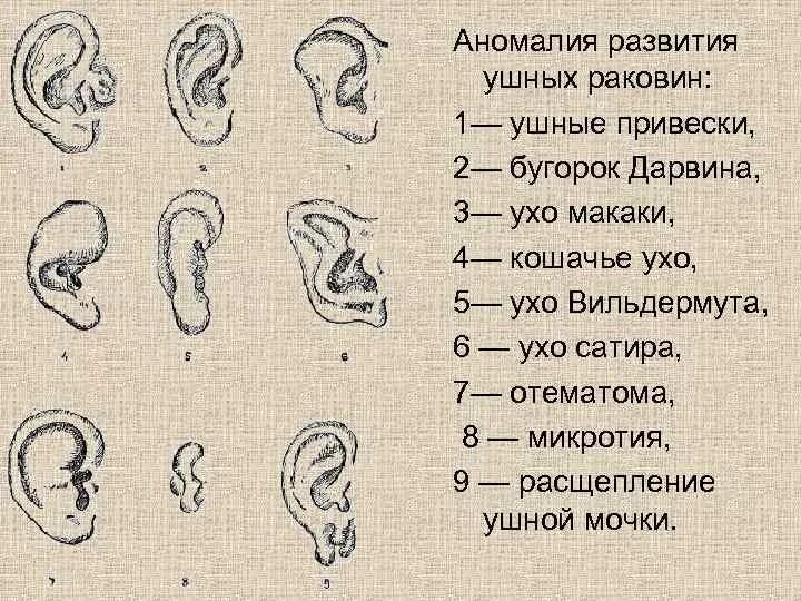Форма мочки ушной раковины. Врожденные аномалии наружного уха. Аномалии ушной раковины ухо макаки. Анатомия ушной раковины уха человека.