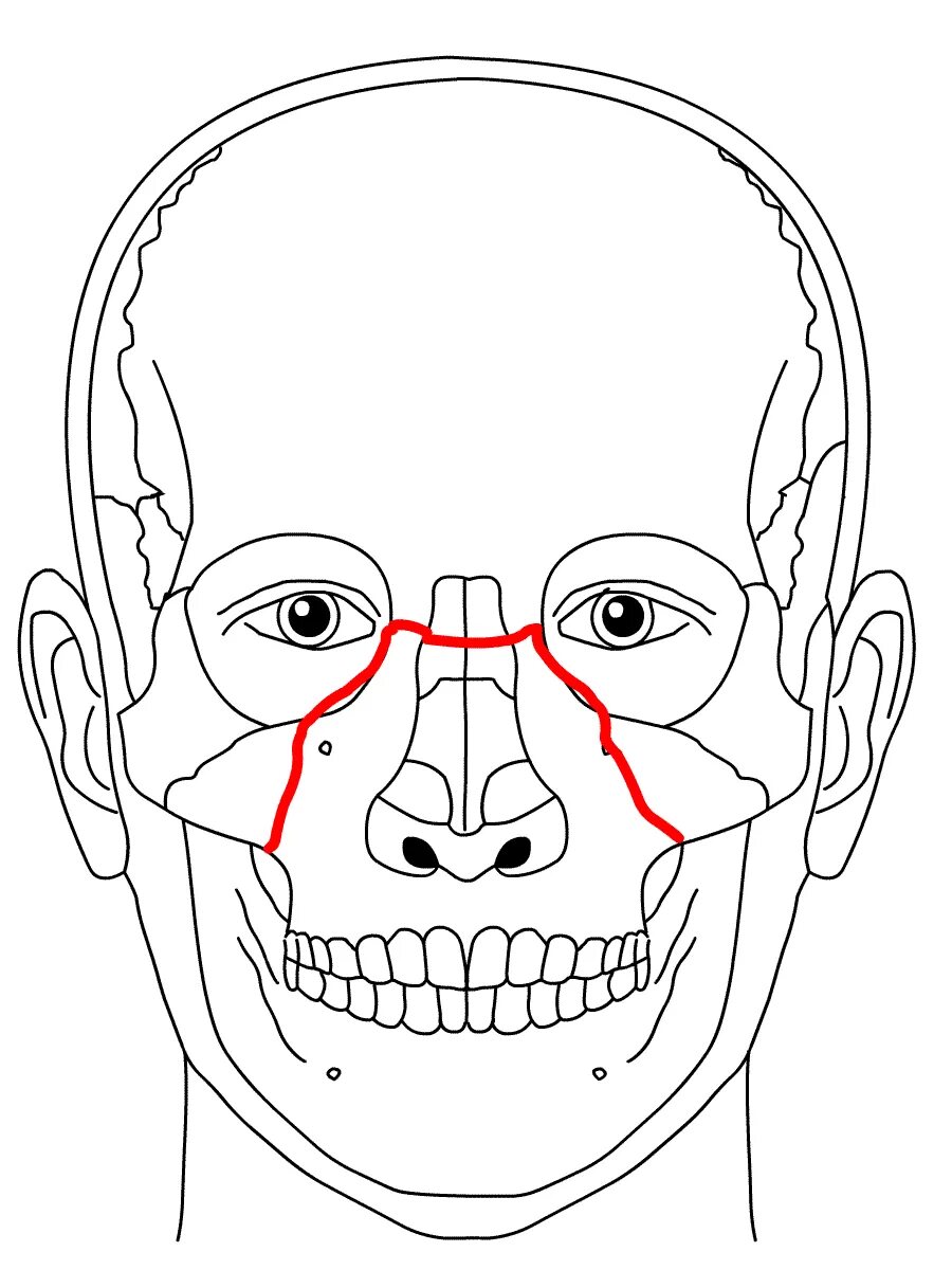 Le fort. Лефор переломы верхней челюсти. Перелом верхней челюсти Лефор 2. Перелом верхней челюсти по Лефору.