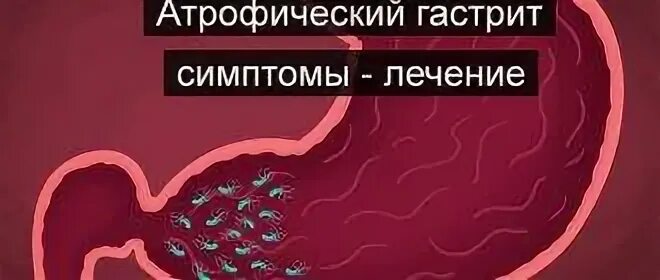 Форум атрофическим гастритом желудка. Атрофический гиперпластический гастрит. Атрофический антральный гастрит. Атрофический гиперпластический гастрит симптомы.