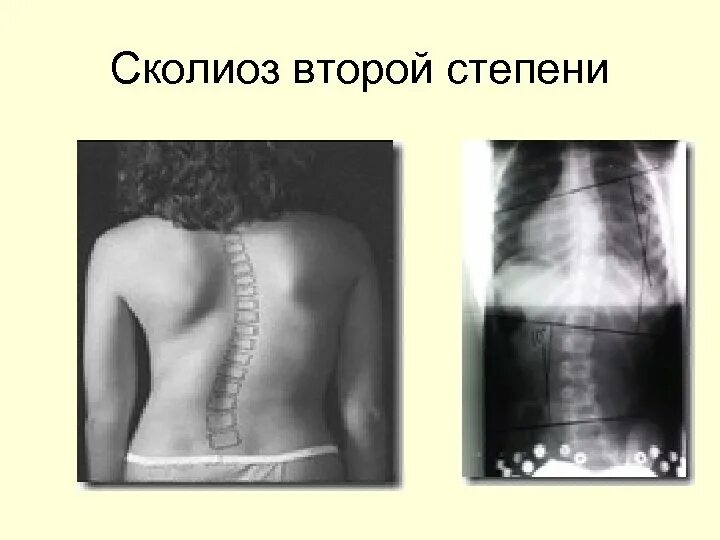Сколиоз 8 степени. Левосторонний сколиоз 2й степени. с-образный сколиоз грудного отдела позвоночника 2 степени по чаклину. сколиотическая болезнь 2 степени. сколиотическая деформация позвоночника 2 степени.