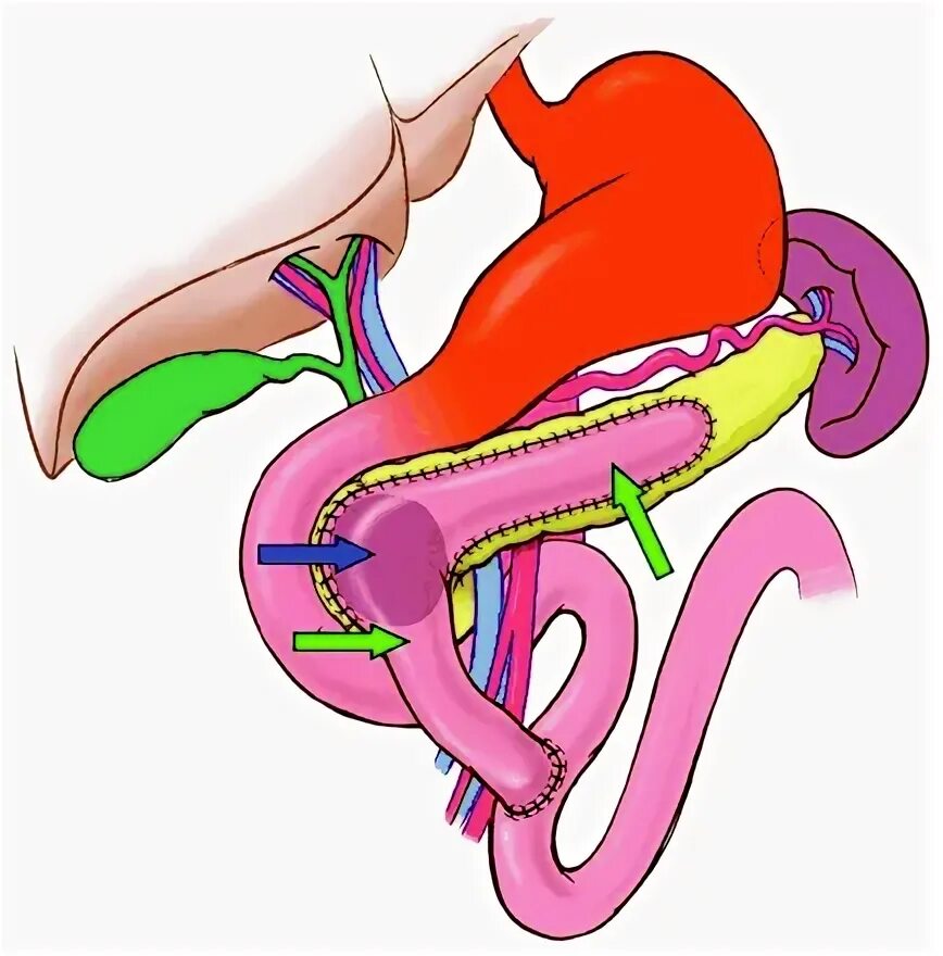 Пдр операция. Операция Бегера на поджелудочной железе. Операция Фрея на поджелудочной. Операция Фрея на поджелудочной железе схема.