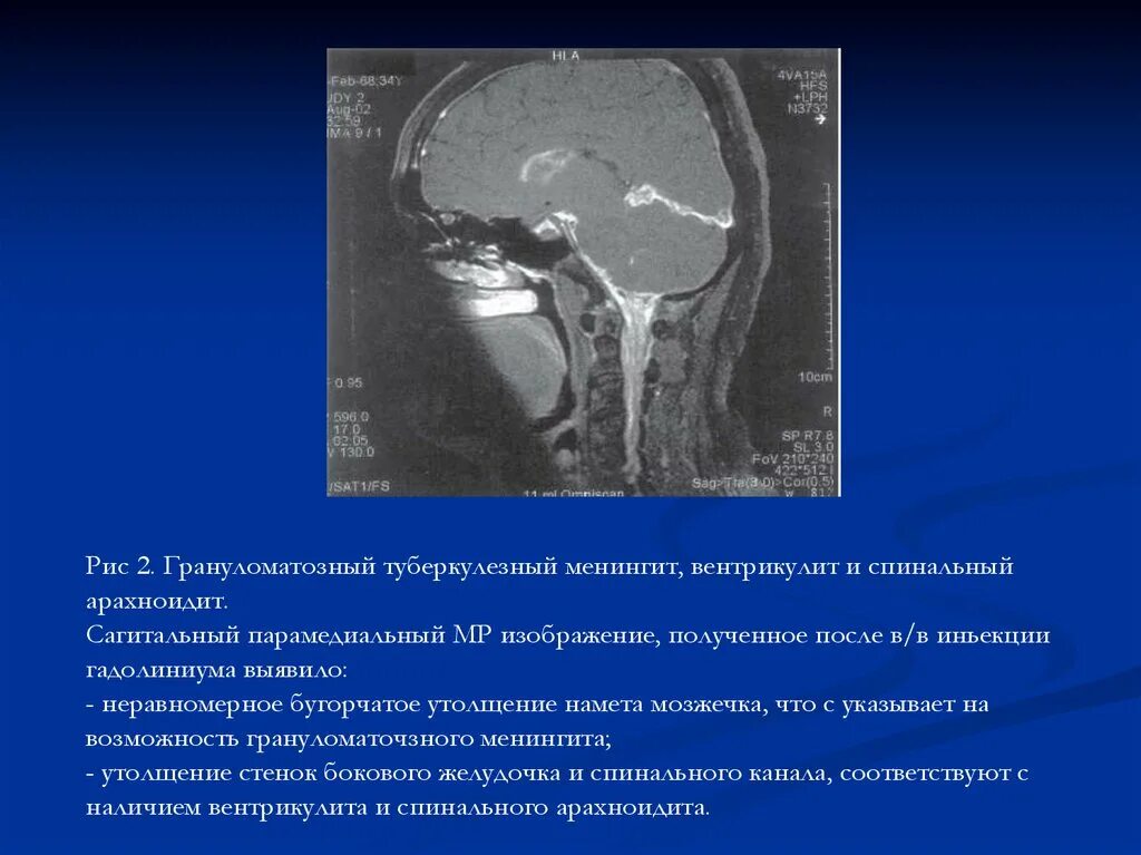 Туберкулез мозговых оболочек