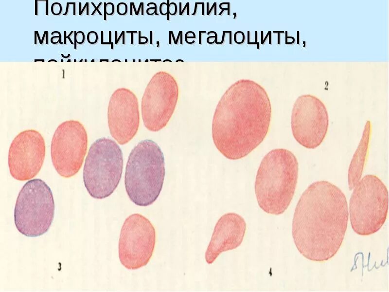 Пониженные макроциты. Анемия макроциты пойкилоцитоз. Макроциты и мегалобласты. Микроциты макроциты мегалоциты. Мегалоциты в крови.