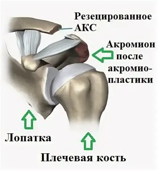 Дегенеративные изменения акромиально ключичного сочленения. Дегенеративные изменения акромиально ключичного сочленения