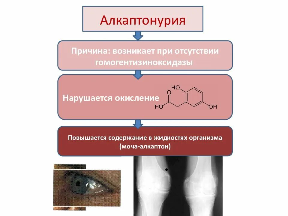 Фенилкетонурия моногенное заболевание возникающее в результате. Алкаптонурия, механизм возникновения. Алкаптонурия реакция биохимия. Алкаптонурия механизм развития. Алкаптонурия клиническая картина.