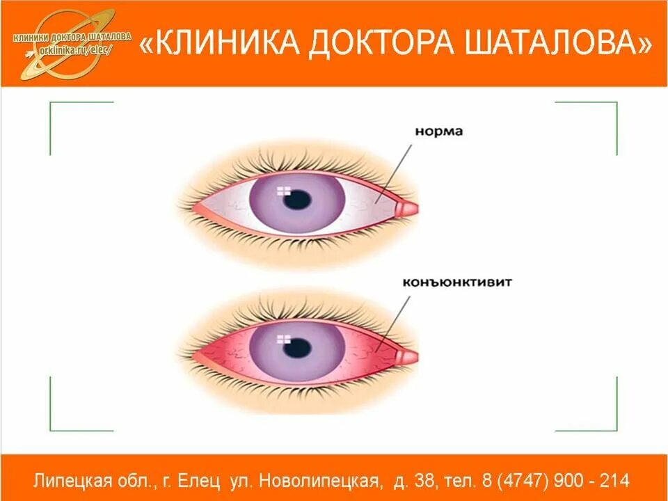 Конъюнктивит инородное тело. Клиника глаза конъюнктивит.