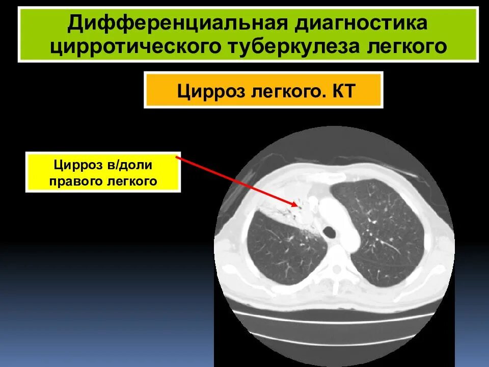 Цирроз на кт. Цирротический туберкулез легких. цирротический туберкулез легких кт. цирроз средней доли легкого.