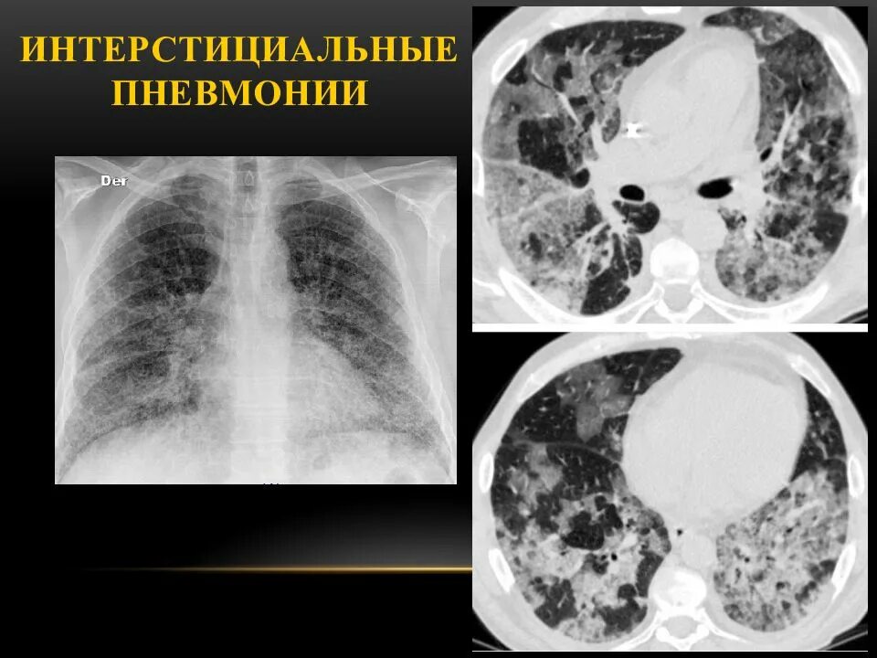 Острая интерстициальная пневмония кт. Неспецифическая интерстициальная пневмония кт. Лимфоидная интерстициальная пневмония кт. Крупозная и интерстициальная пневмония. Полость заболевания легких