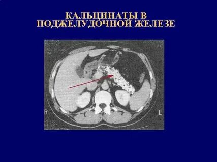 Кальцинаты железы