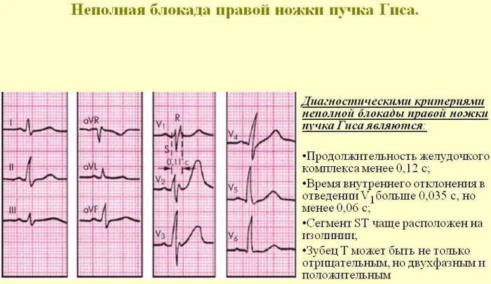 Блокада qrs. Блокада ЛНПГ на ЭКГ. М образный комплекс QRS В v3. Блокада правой ножки Гиса v1 v2. Полная блокада левой ножки пучка Гиса на ЭКГ.