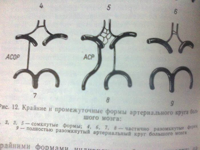 Правая задняя трифуркация. Вариантная анатомия Виллизиева круга. Трифуркация Виллизиева круга. Передняя трифуркация ВСА схема. Виллизиев круг трифуркация.