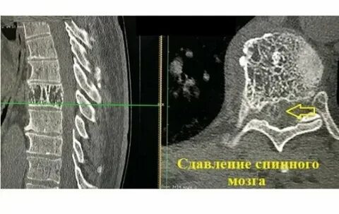 Гемангиома позвонка как лечить
