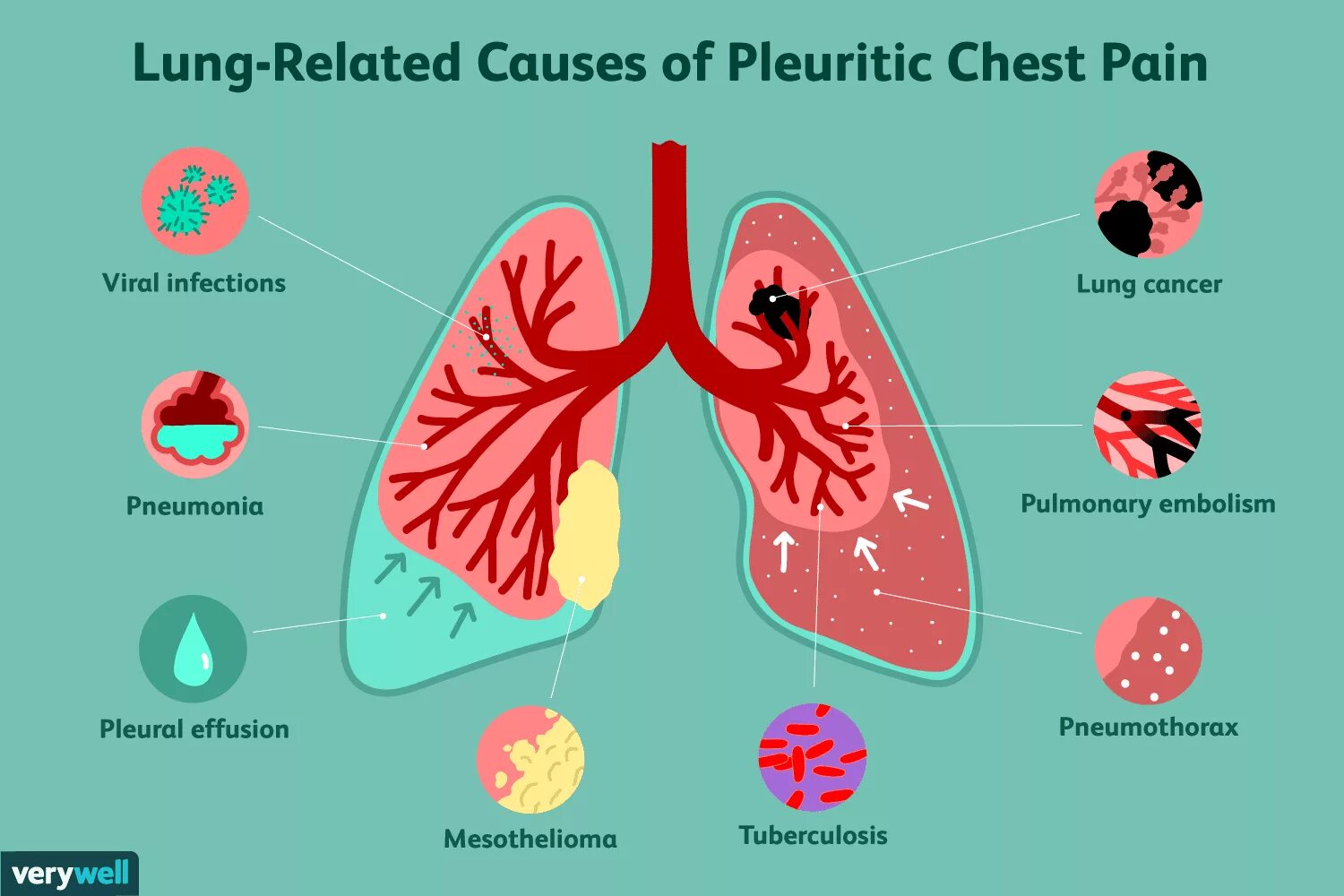 Causes of Chest Pain.