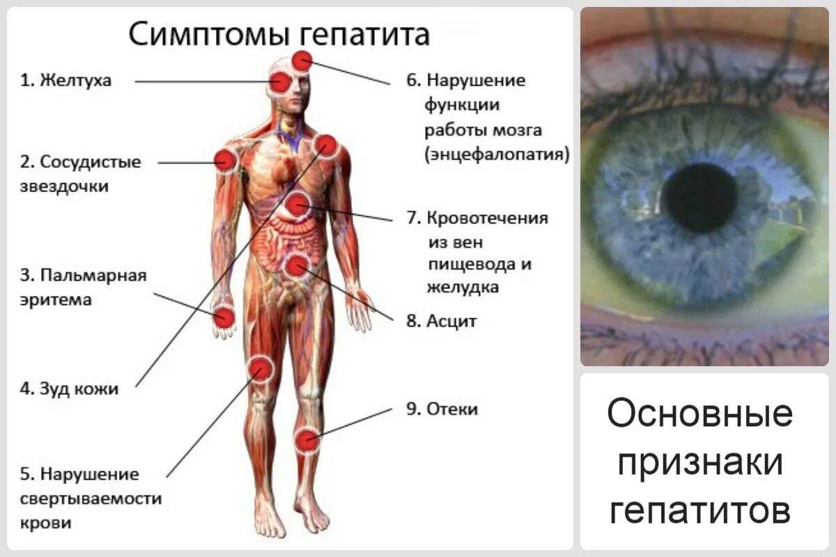 Гепатит проявляется через. Вирусный гепатит симптомы.