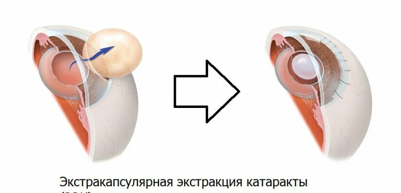 Катаракта.А если подождать? Ophthalmodoc Дзен