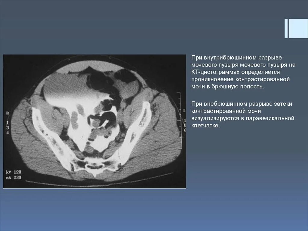 Паравезикальная клетчатка. Интраперитонеальный разрыв мочевого пузыря. Внутрибрюшинное ранение мочевого пузыря. Внутрибрюшное повреждение мочевого пузыря. Кт при разрыве мочевого пузыря.