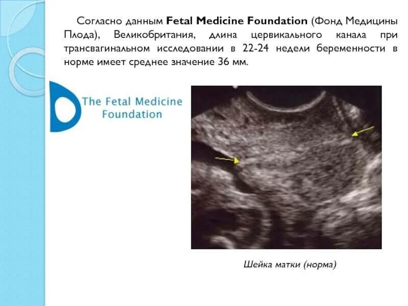 Цервикальный канал при беременности норма 20 недель. Короткая шейка матки 28 мм при беременности. Шейка матки при беременности УЗИ. Ширина цервикального канала в норме.