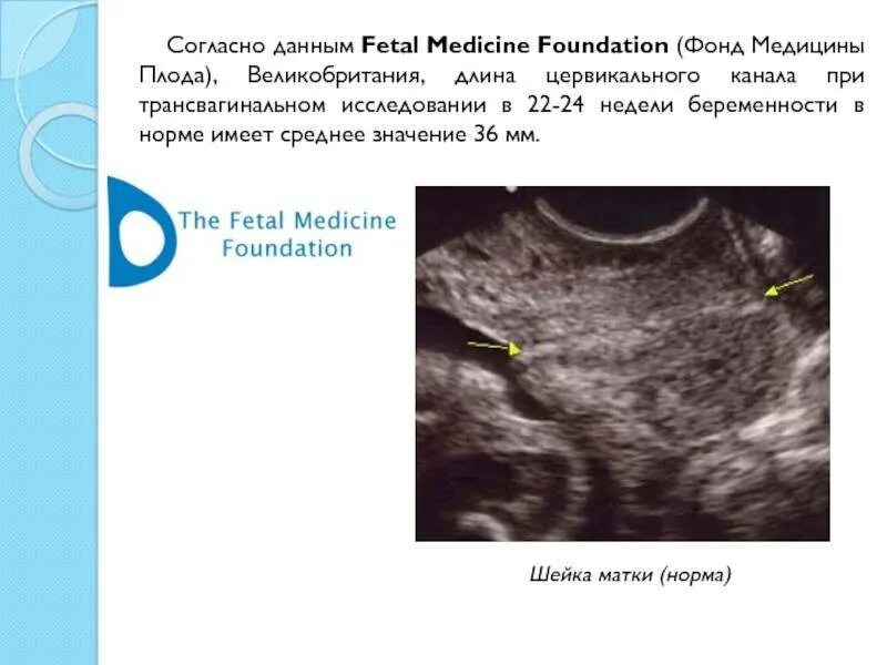 Как удлинить шейку при беременности. Цервикальный канал при беременности норма 20 недель. Короткая шейка матки 28 мм при беременности. Шейка матки при беременности УЗИ. Ширина цервикального канала в норме.