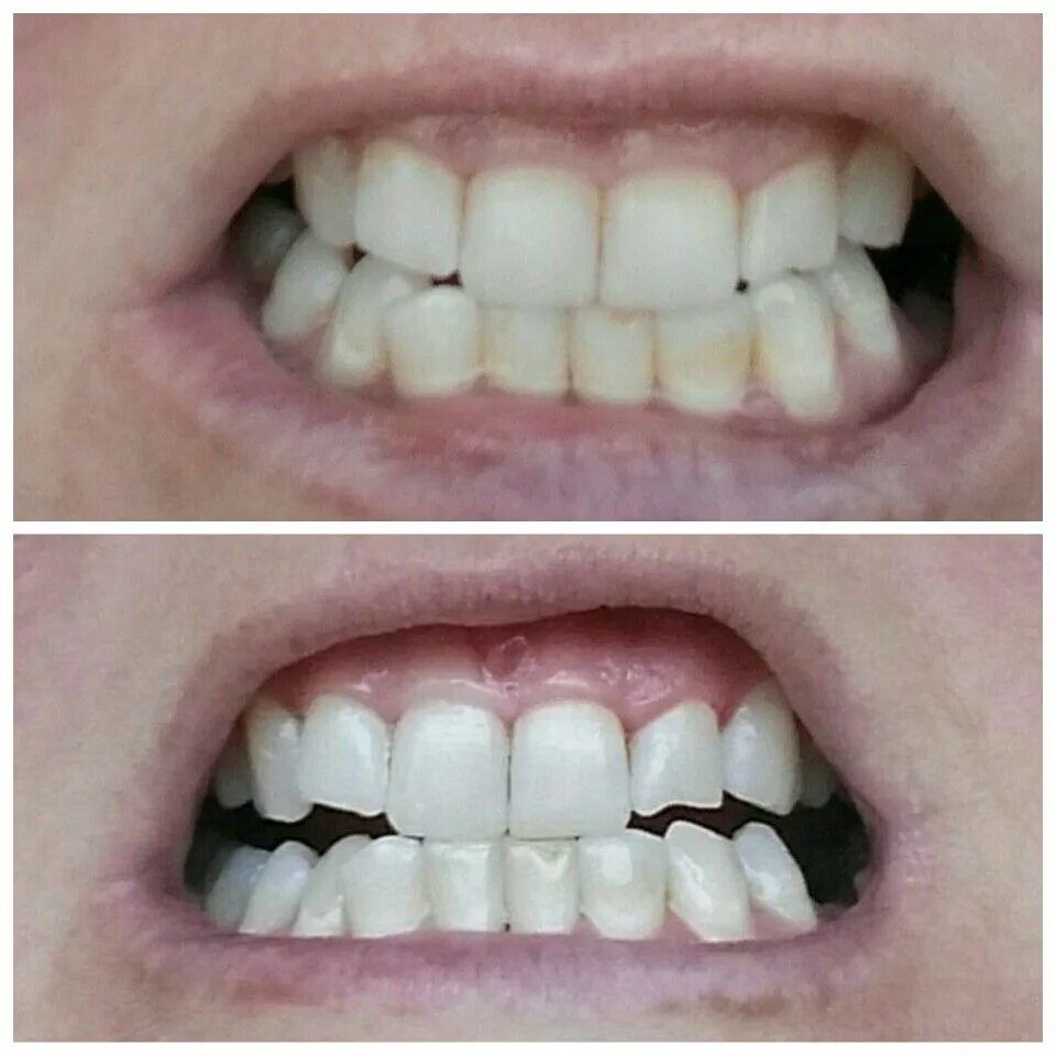 Отбеливание зубов. Отбеливание зубов содой до и после.
