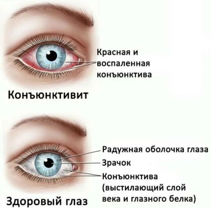 Насморк конъюнктивит температура у ребенка. Коньюктивит гнойный конъюнктивит. воспалился глаз конъюнктивит. глазная болезнь конъюнктивит. конъюнктивит нижнее веко.