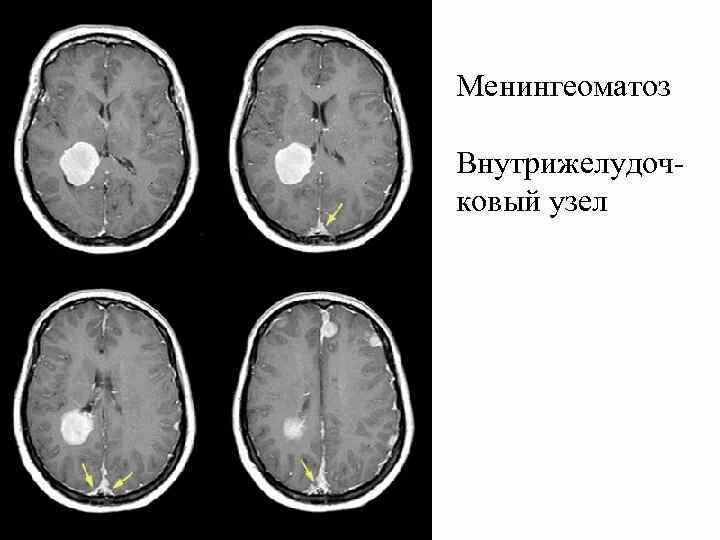 Астроцитома головного мозга прогноз. Пилоидная астроцитома. Глиальная астроцитома. Пилоидная астроцитома мрт.